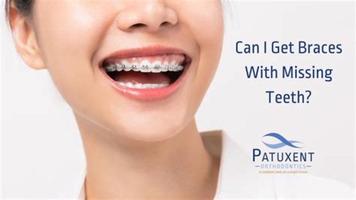 What Was Wrong With Bray Wyatt Teeth? Used Braces Or Whitening